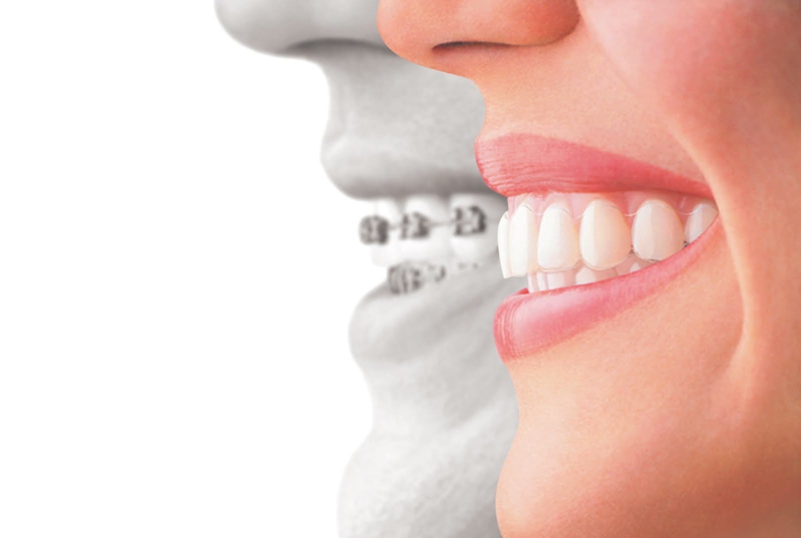 traditional braces vs invisalign