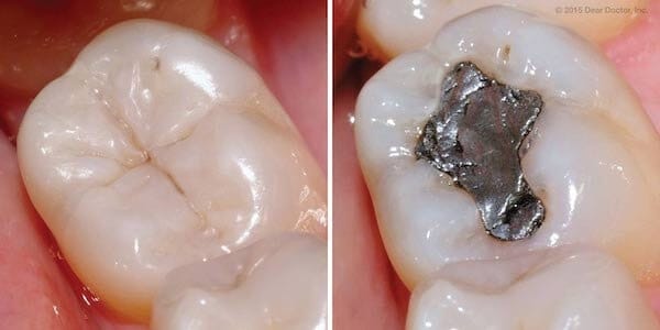 composite vs amalgam fillings