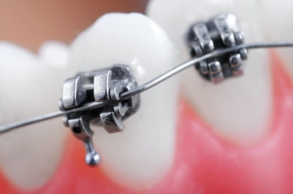 Showing how brackets adjust teeth positions