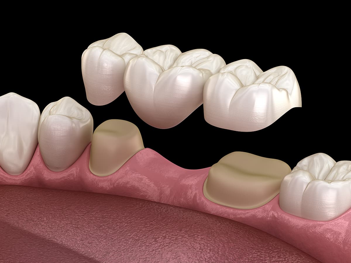 Traditional Dental Bridges