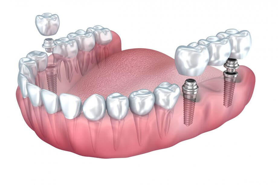 Implant-supported Bridges