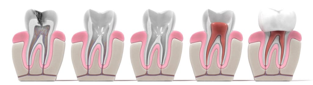 Root Canal Therapy Process