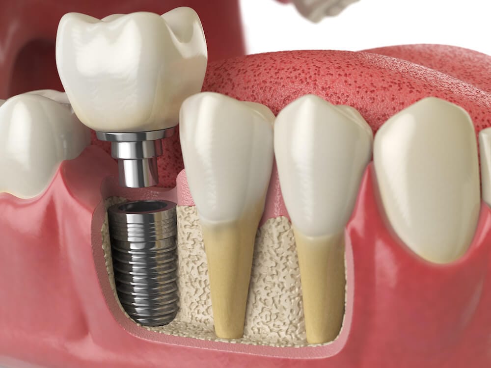 How to Choose an Implant Dentist: Everything You Need to Know