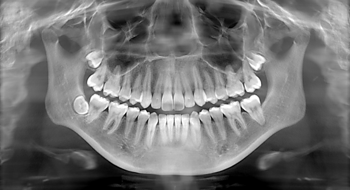 panoramic dental xray