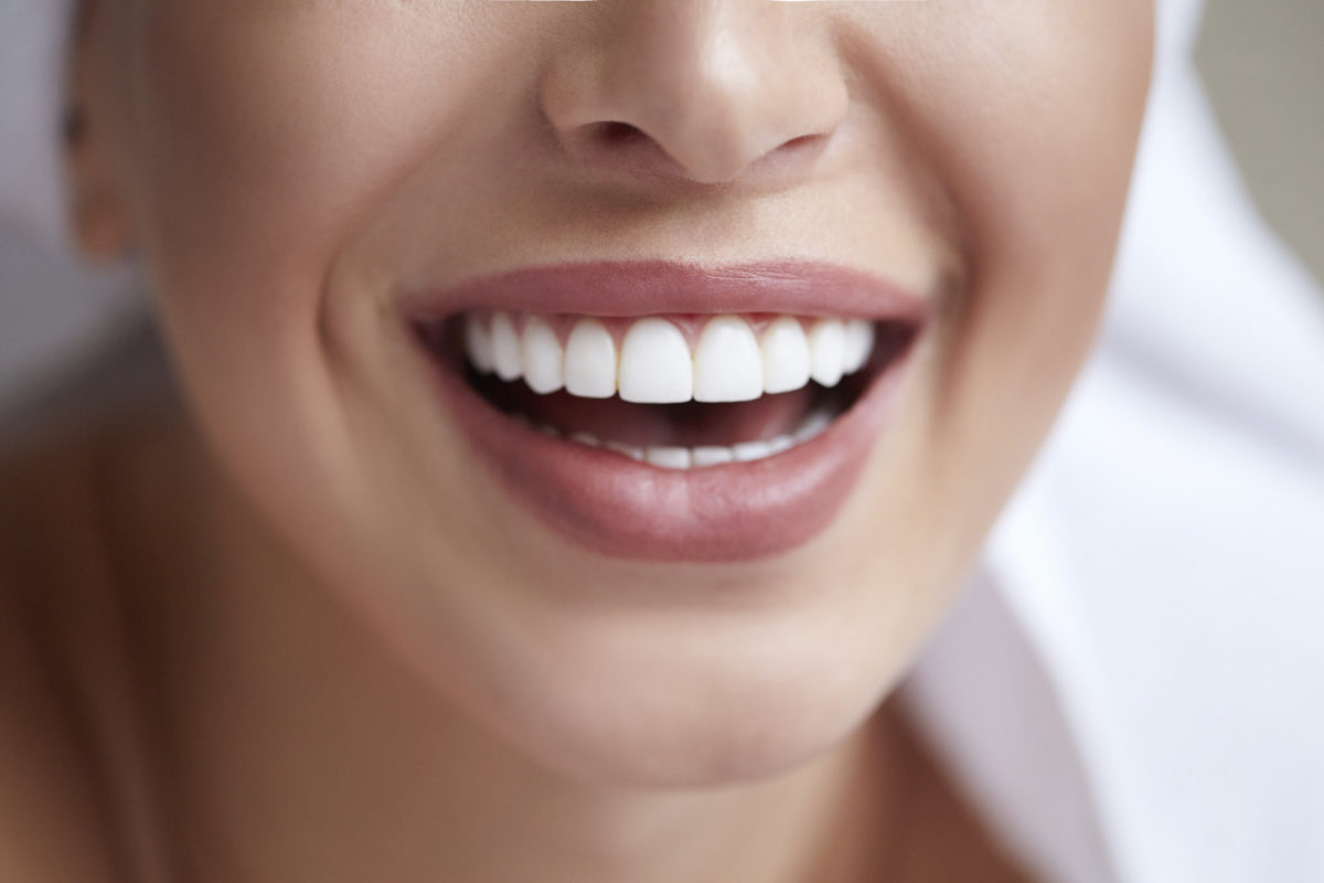 What Are the Different Types of Veneers?