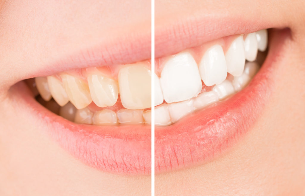 Teeth Whitening How Does Professional Teeth Whitening Work?
