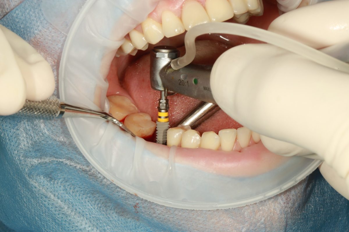 How to Choose Dental Implant Specialists: Everything You Need to Know