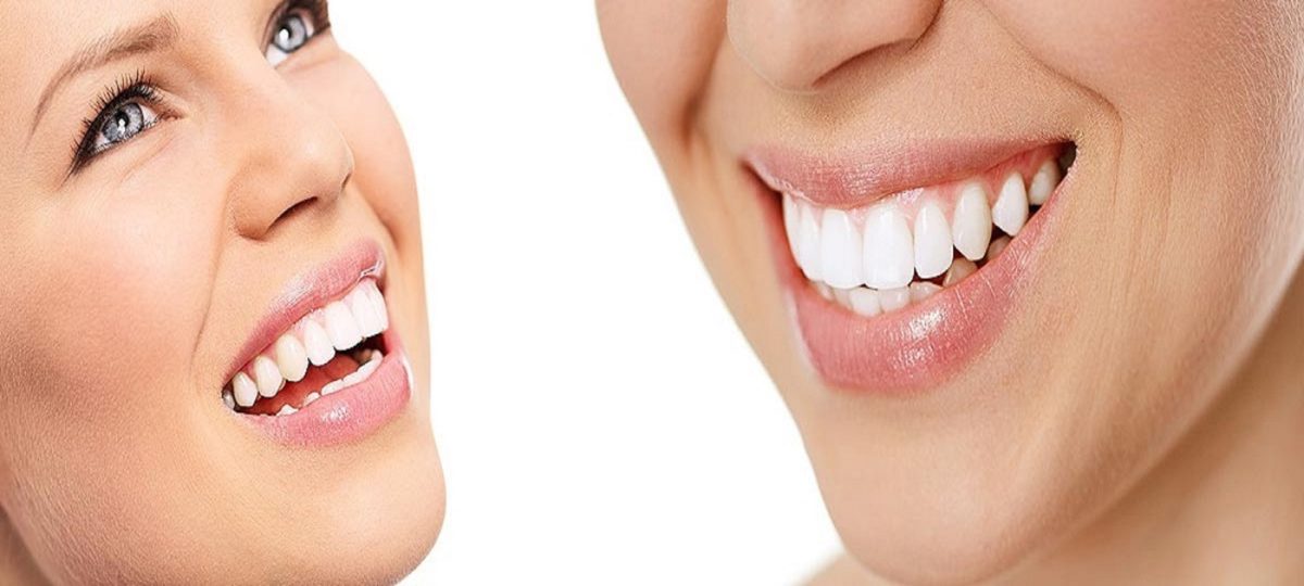 Whitening Teeth: 5 Things You Need to Know