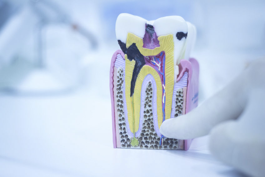 Recovery After Root Canal Therapy